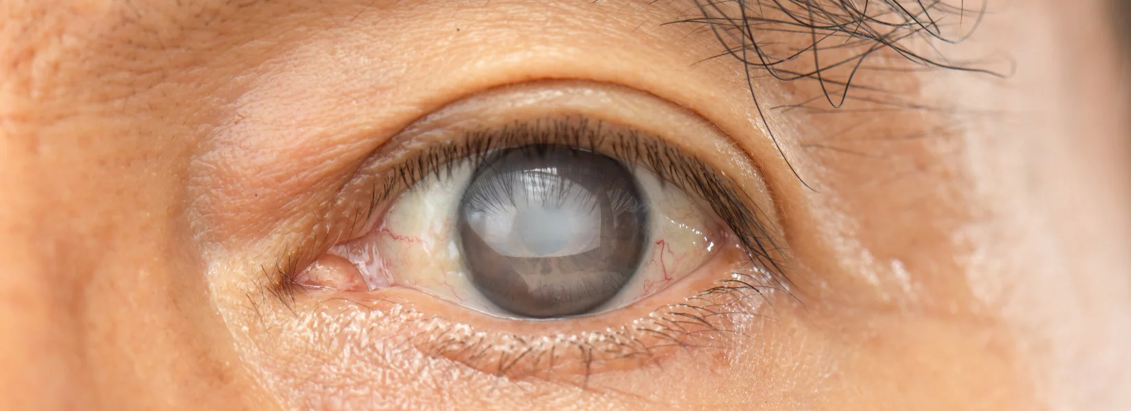 Cataract Surgery in Patna - Drishtikunj Netralaya