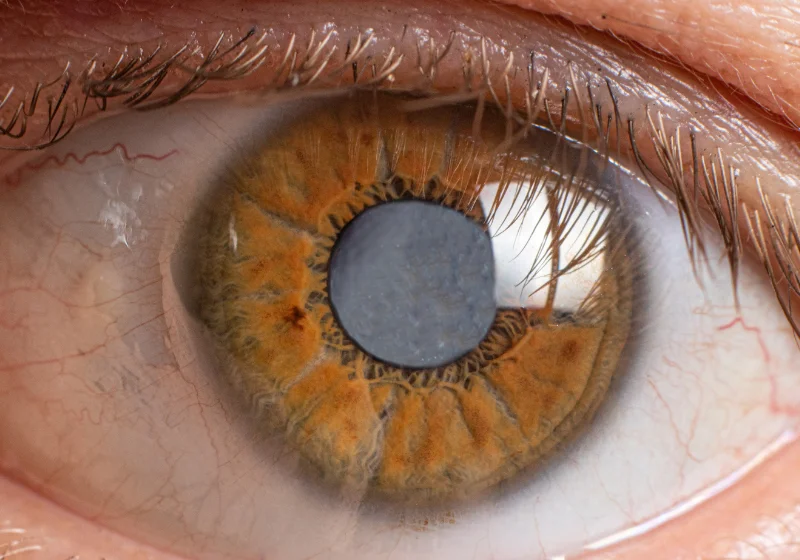 Cataract Treatment - Drishtikunj Netralaya Image