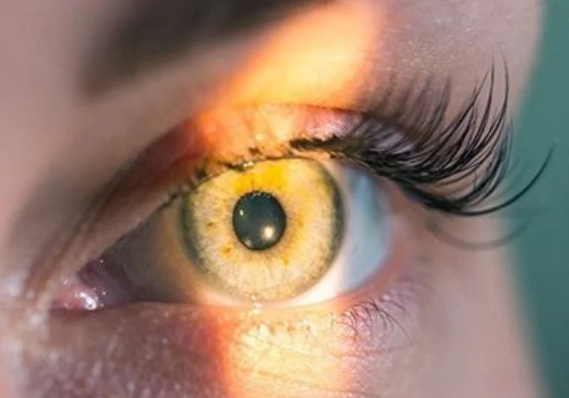 Cornea Care - Drishtikunj Netralaya Image