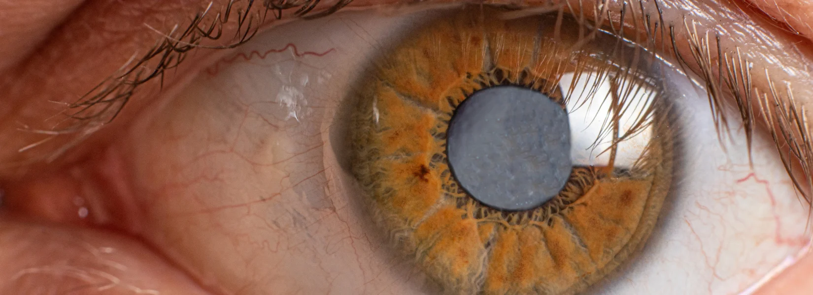 Glaucoma Drishtikunj Netralaya - Post Bannen Image