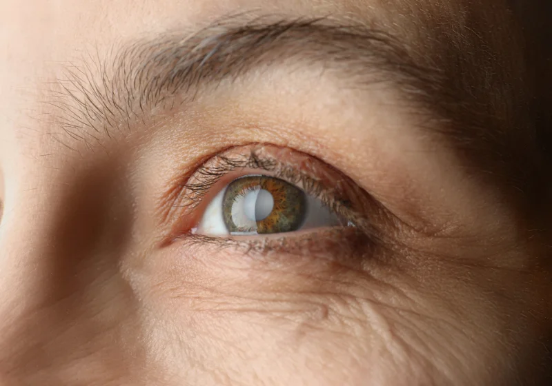 Glaucoma Treatment - Drishtikunj Netralaya Image