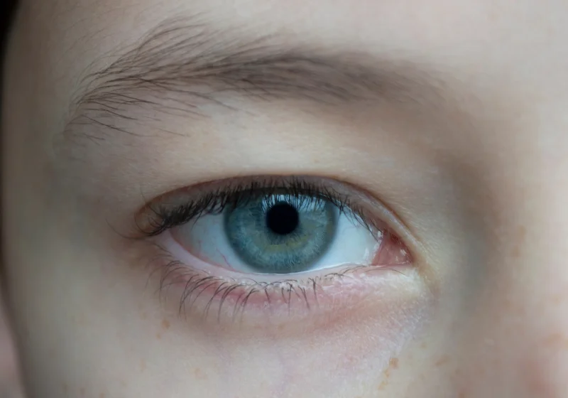 Retinal Detachment - Drishtikunj Netralay Image